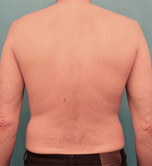 Male Liposuction Patient