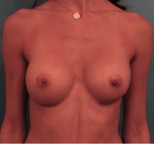 Breast Augmentation Patient After NYC