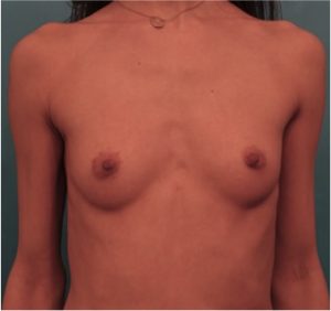 Breast Augmentation Patient Before NYC