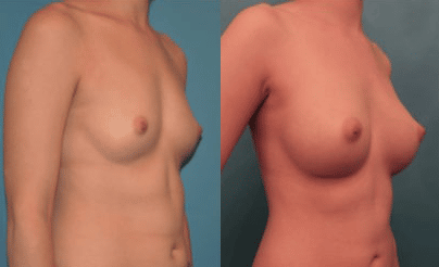 Breast Augmentation NYC Patient #2 - Before & After Photo