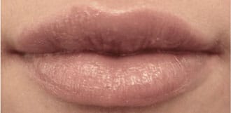 Restylane Silk before & after patient nyc Restylane Silk before & after patient nyc