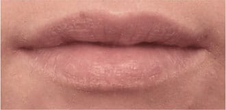Restylane Silk before & after patient nyc Restylane Silk before & after patient nyc