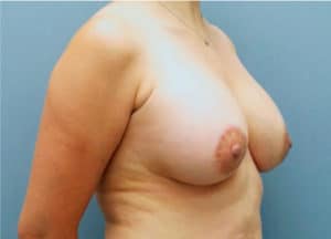 Breast Lift Patient #3 After - NYC