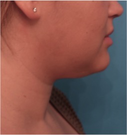 Kybella Patient #14 Before Photo # 7