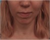 Kybella Patient #10 Before Photo Thumbnail # 1