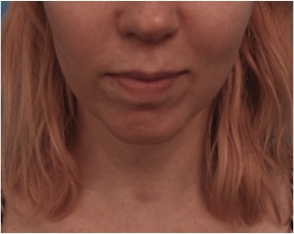 Before Image: Kybella Patient #10 - 