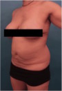 Abdominoplasty/ Tummy Tuck Patient #10 Before Photo Thumbnail # 3