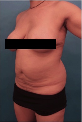 Abdominoplasty/ Tummy Tuck Patient #10 Before Photo # 3