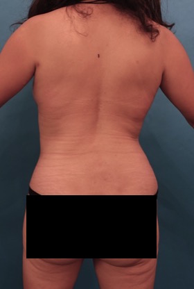 Abdominoplasty/ Tummy Tuck Patient #10 After Photo # 10