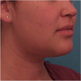 Kybella Patient #14 After Photo # 10
