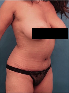 Abdominoplasty/ Tummy Tuck Patient #10 After Photo # 14