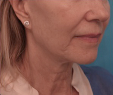 Kybella Patient #9 After Photo Thumbnail # 8