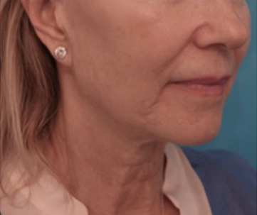 Kybella Patient #9 After Photo # 8