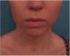 Kybella Patient #10 After Photo Thumbnail # 2