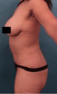 Abdominoplasty/ Tummy Tuck Patient #10 After Photo Thumbnail # 6
