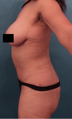 Abdominoplasty/ Tummy Tuck Patient #10 After Photo # 6