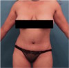 Abdominoplasty/ Tummy Tuck Patient #10 After Photo Thumbnail # 2