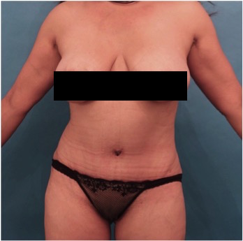 Abdominoplasty/ Tummy Tuck Patient #10 After Photo # 2