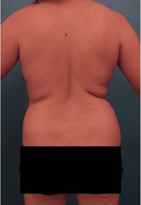 Abdominoplasty/ Tummy Tuck Patient #10 Before Photo # 9