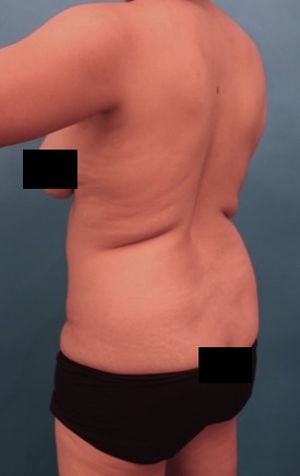 Abdominoplasty/ Tummy Tuck Patient #10 Before Photo # 7