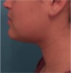 Kybella Patient #14 After Photo Thumbnail # 4