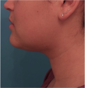 Kybella Patient #14 After Photo # 4