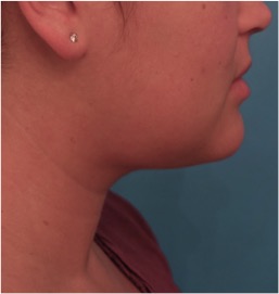 Kybella Patient #14 After Photo # 8