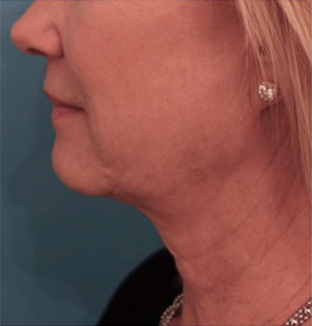 Kybella Patient #9 Before Photo # 5