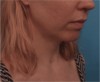 Kybella Patient #10 Before Photo Thumbnail # 3