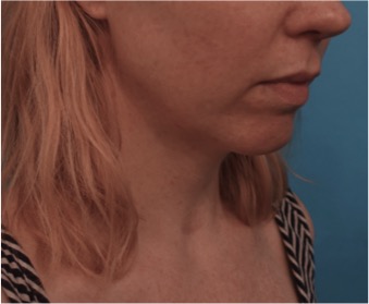 Kybella Patient #10 Before Photo # 3