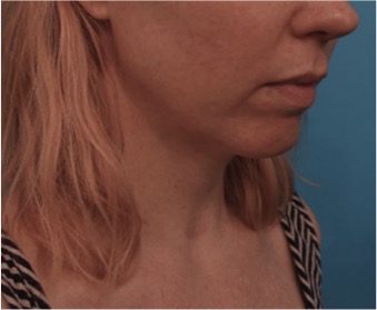 Before Image: Kybella Patient #10 -