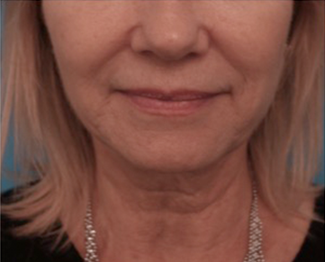 Kybella Patient