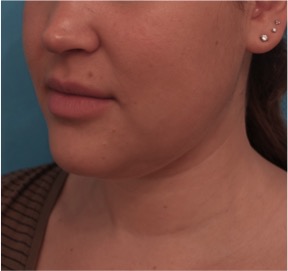 Kybella Patient #14 Before Photo # 5