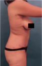 Abdominoplasty/ Tummy Tuck Patient #10 After Photo Thumbnail # 12