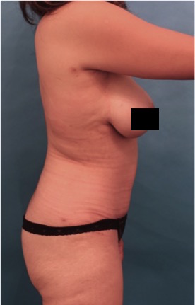 Abdominoplasty/ Tummy Tuck Patient #10 After Photo # 12