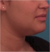 Kybella Patient #14 Before Photo Thumbnail # 9