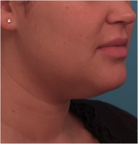 Kybella Patient #14 Before Photo # 9
