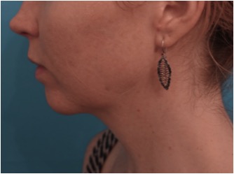 After Image: Kybella Patient #10 -