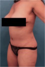 Abdominoplasty/ Tummy Tuck Patient #10 After Photo Thumbnail # 4