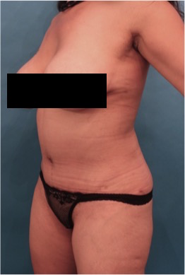 Abdominoplasty/ Tummy Tuck Patient #10 After Photo # 4