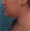 Kybella Patient #14 Before Photo Thumbnail # 3