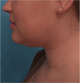 Kybella Patient #14 Before Photo # 3