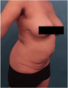 Abdominoplasty/ Tummy Tuck Patient #10 Before Photo Thumbnail # 13