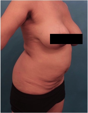 Abdominoplasty/ Tummy Tuck Patient #10 Before Photo # 13