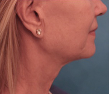 Kybella Patient #9 After Photo # 4