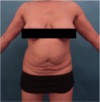 Abdominoplasty / Tummy Tuck Patient