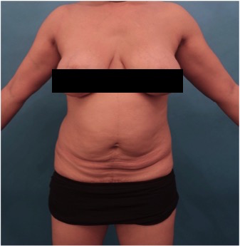 Abdominoplasty/ Tummy Tuck Patient #10 Before Photo # 1