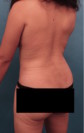 Abdominoplasty/ Tummy Tuck Patient #10 After Photo Thumbnail # 8