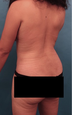 Abdominoplasty/ Tummy Tuck Patient #10 After Photo # 8