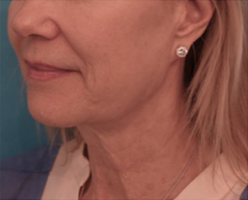 Kybella Patient #9 After Photo # 10